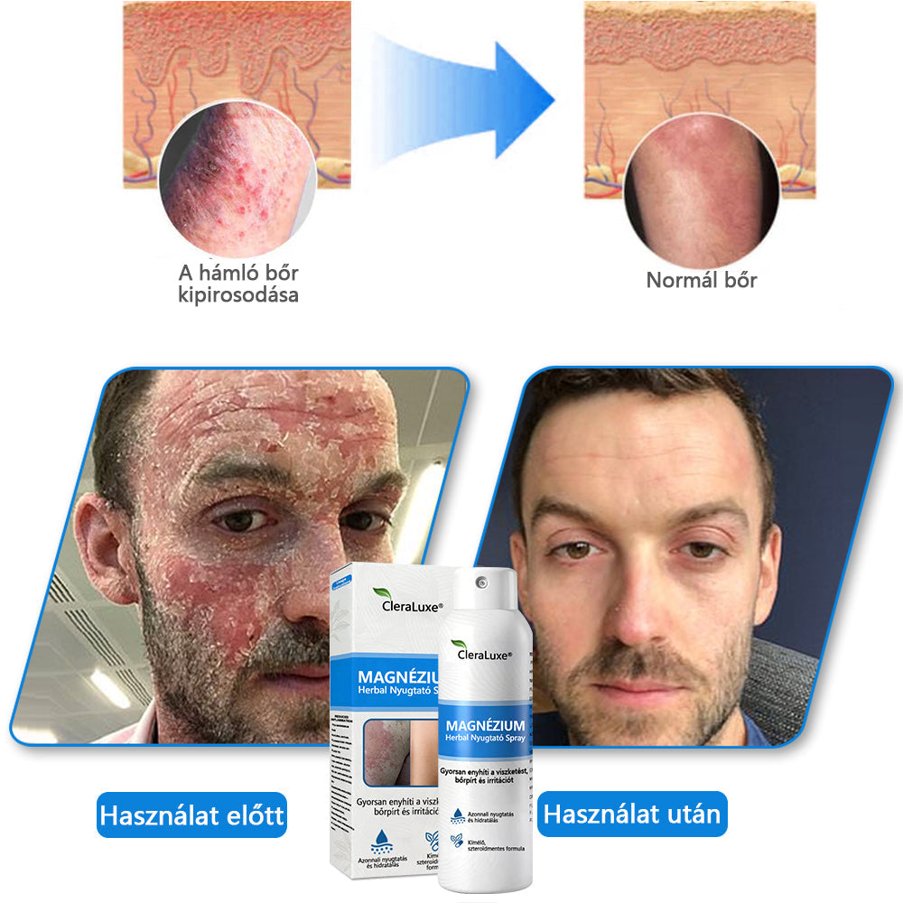 CleraNature® Magnéziumos Spray – Gyors Enyhülés Viszkető, Vörös és Érzékeny Bőrre (Még Intim Területeken is)✨