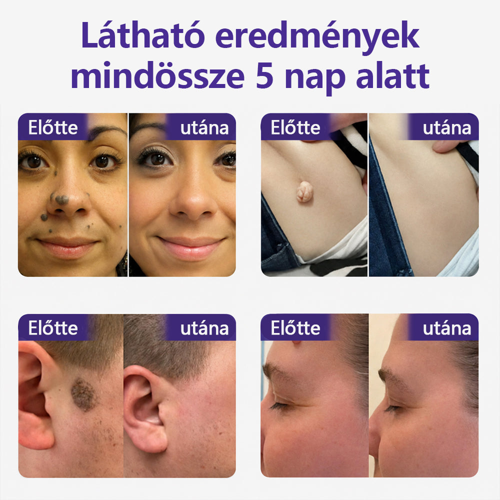 👩🏻‍⚕️COLTURE® szemölcs- és anyajegytávolító mikrotűs tapasz