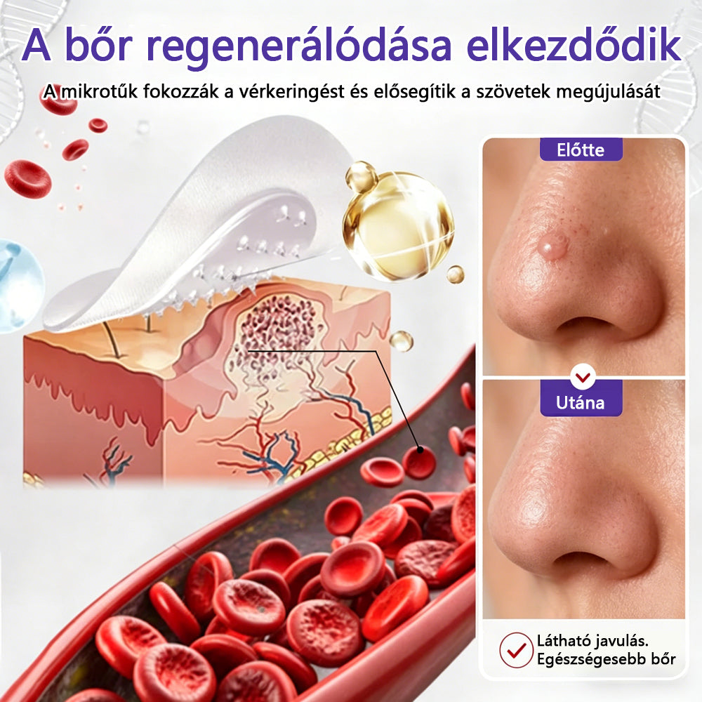 👩🏻‍⚕️COLTURE® szemölcs- és anyajegytávolító mikrotűs tapasz