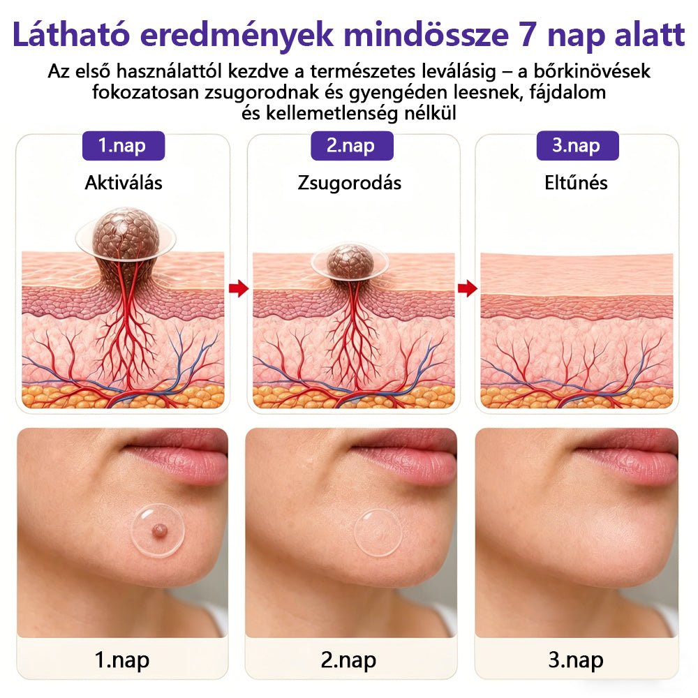 👩🏻‍⚕️COLTURE® szemölcs- és anyajegytávolító mikrotűs tapasz